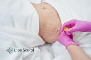 Are The Results From Aqualyx Permanent? 1 Do you want to know how long Aqualyx Welwyn Garden City results last?
