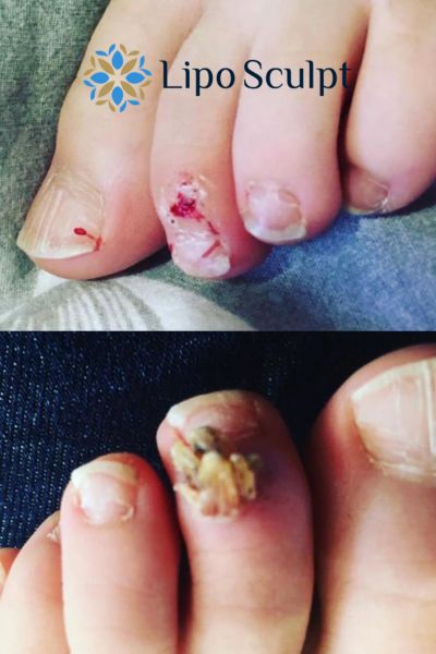 Wart removal customer results from Lipo Sculpt Welwyn Garden City